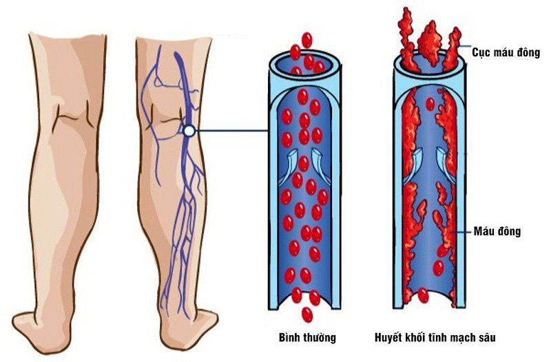 Các kỹ thuật xét nghiệm D - dimer nên làm khi nào? | Medlatec