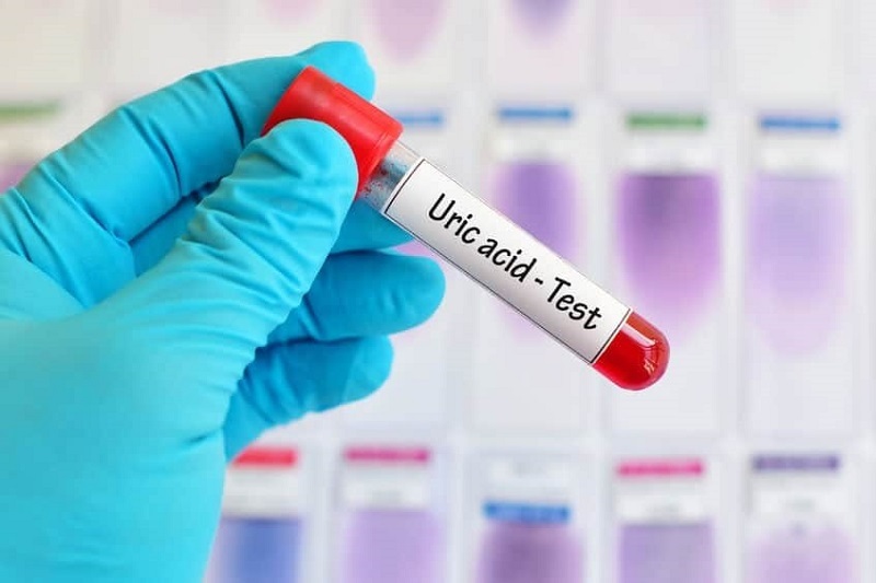 Nồng độ acid uric trong máu bao nhiêu là bị Gout? | Medlatec
